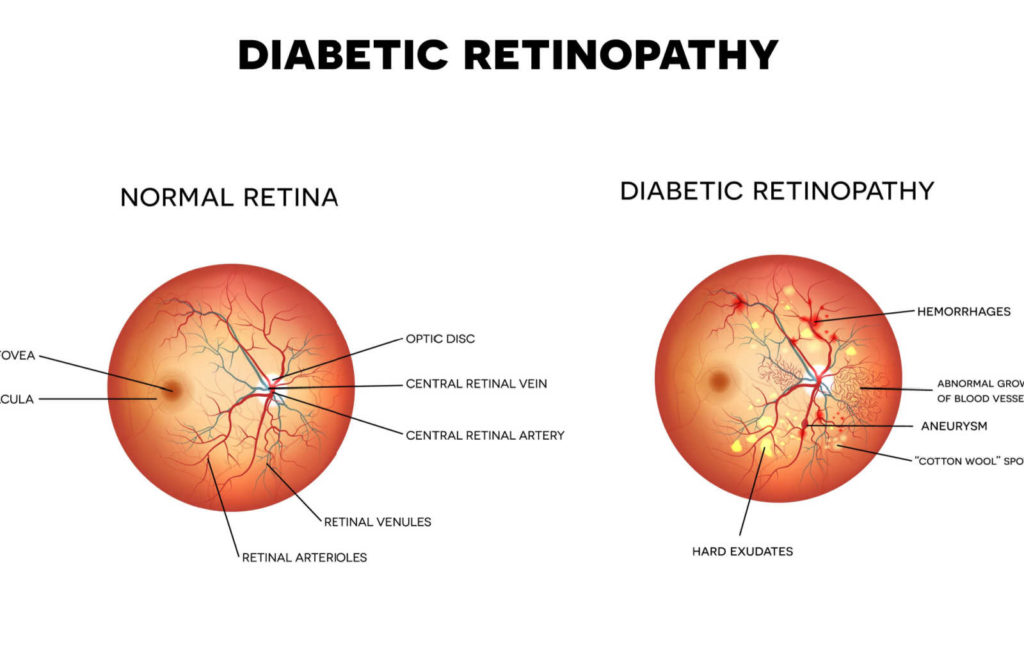 A diagram showing the difference between a normal retina and diabetic retinopathy